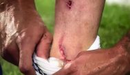 Juventus, Mandzukic mostra la caviglia dopo l’intervento di Matias Vecino